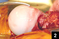 Cam lesion of the femoral neck