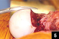 Cam lesion of the femoral neck, after resection